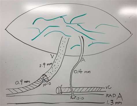 Vascularized Lymph Vessel Transfer For Extremity Lymphedema Is