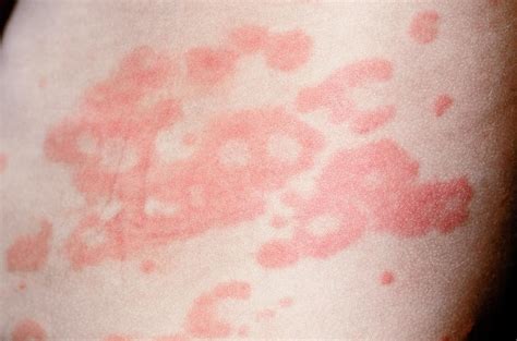 Urticaria Rash On The Skin Photograph By Dr P Marazziscience Photo
