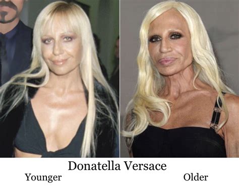 Pin By Julie Klein On Celebrities Then Now Before After Donatella Versace Plastic
