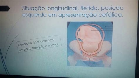 Feto Unico Em Situação Longitudinal