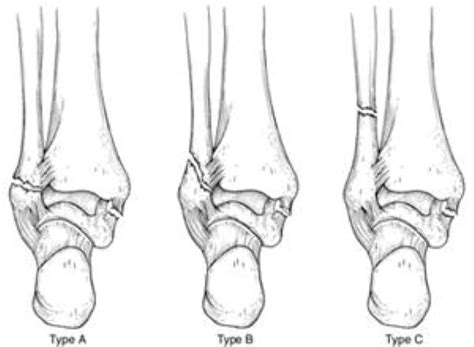 Ankle Fractures Broken Ankle Orthoinfo Aaos