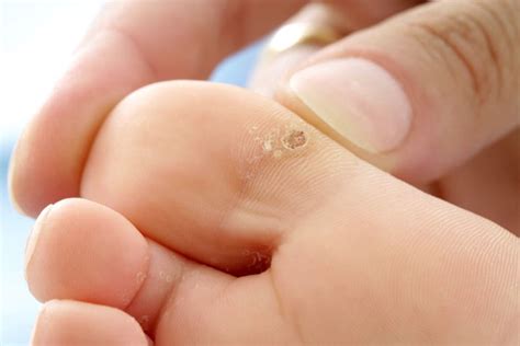 How Do I Get Rid Of Warts On My Feet The Footcare Clinic