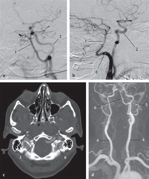 Development Of The Arteries Of The Head Radiology Key