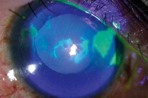 Community Eye Health Journal Diagnosing And Managing Microbial Keratitis