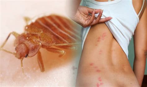 4 Signs Of Bed Bugs And A Remedy For Bug Bites Hopingfor
