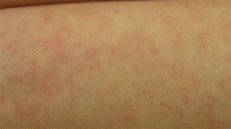 Skin Rash Stress Hives