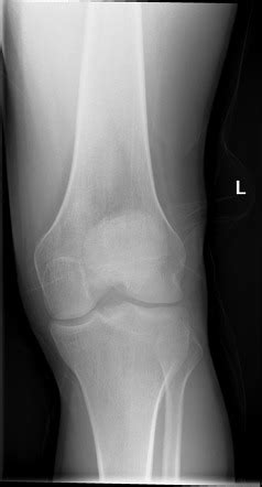 Tibial Plateau Fracture Radiology Case Radiopaedia Org