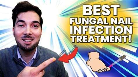 How To Get Rid Of A Fungal Nail Best Treatment Youtube