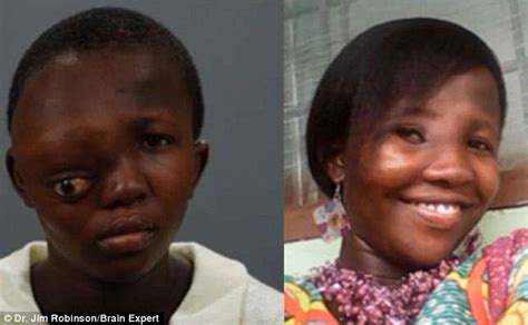African Girl Who Had Rare Brain Surgery To Remove Tumor Is Now Training