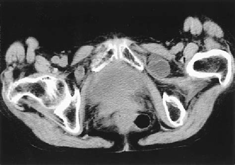 Figure 1 From A Case Of Recurrent Bilateral Obturator Hernias After