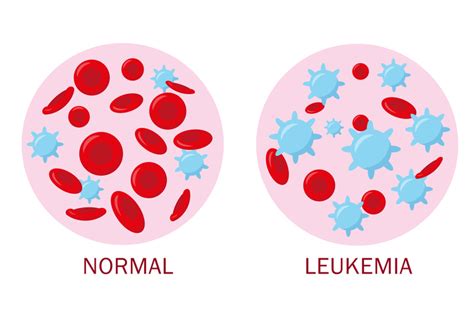 Qué Es La Leucemia Cuáles Son Sus Síntomas Y Cómo Se Trata