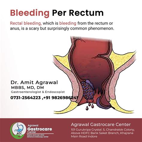 Bleeding Per Rectum Causes Symptoms Treatment Agrawal Gastrocare Center Indore