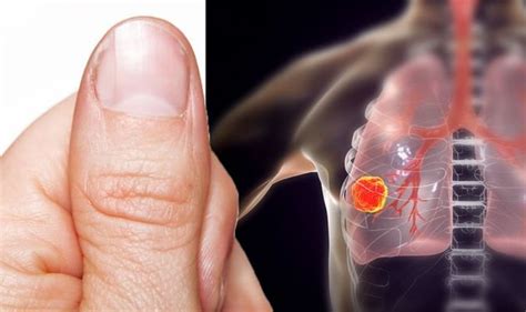 Lung Cancer Symptoms Do Your Nails Feel Like This Warning Sign