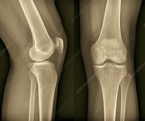 Healthy Knee X Ray Stock Image F006 9125 Science Photo Library