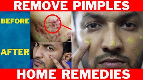 How To Remove Pimples Pimplesacne Treatment Home Remedies Youtube