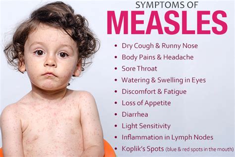 Measles Baby