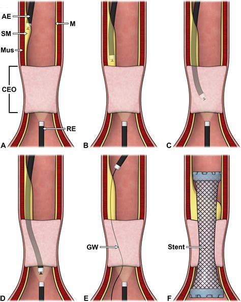 Per Oral Endoscopic Tunneling For Restoration Of The Esophagus A Novel