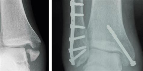 Rehabilitation After Immobilization For Ankle Fracture The Exact Trial