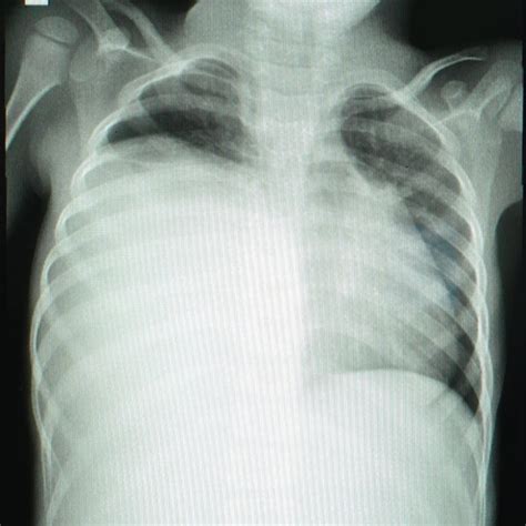 Chest X Ray Showing Opacification Of The Right Hemithorax Download