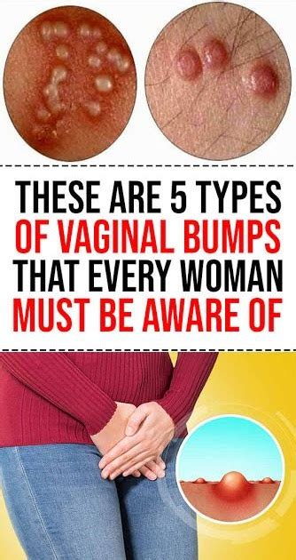 Vaginal Lumps And Bumps Identification Causes And More Healthline My XXX Hot Girl