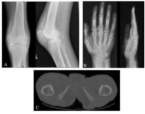 Figure 2 From Imaging Findings In Hypertrophic Osteoarthropathy A