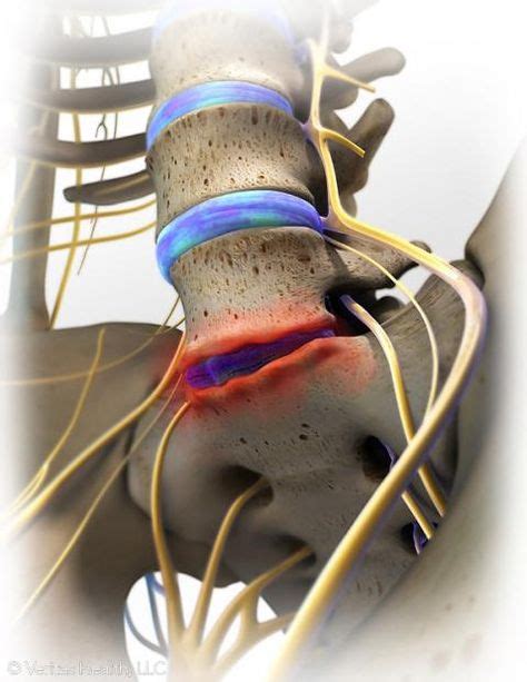 Best Spinal Stenosis Images Spinal Stenosis Spine Health
