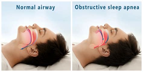 the causes and long term effects of apnea sleep apnea treatment sleep apnea and tmj solutions