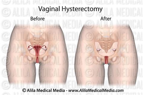 Alila Medical Media Vaginal Hysterectomy Unlabeled