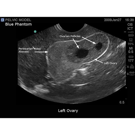 Blue Phantom General Pathology Transvaginal Ultrasound Training Model