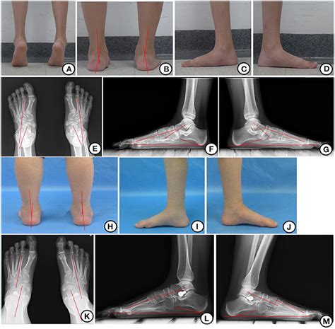 Frontiers Hyprocure For Pediatric Flexible Flatfoot What Affects The