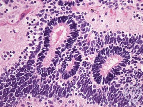 15female Genital Organs 9 Immature Teratomapathology Core Pictures