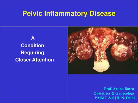 Ppt Pelvic Inflammatory Disease Pid Powerpoint Presentation Free The