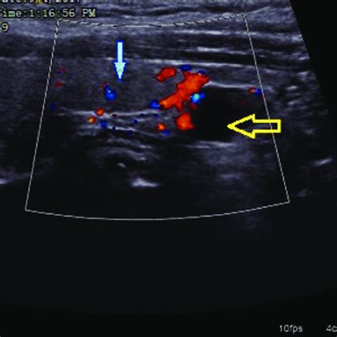 Ultrasound Showing Well Defined Ovoid Hypoechoic Lesion 14 X 8 X 13