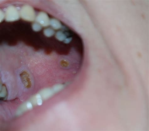 Usually, the malignant growth starts with the tongue and lips, then spread elsewhere. Sores on Roof of Mouth