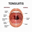 Tonsillitis : Symptoms, Causes, Risk factors and Treatments
