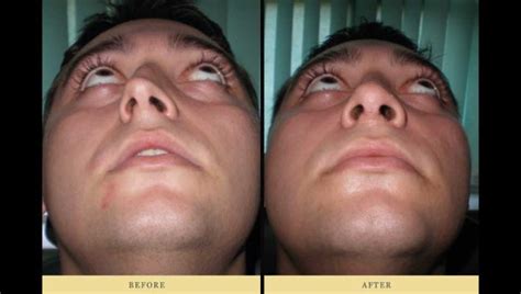 Rhinoplasty And Deviated Nasal Septum Surgery For Right Breath