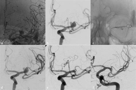 Flow Diverter Devices In The Treatment Of Complex Middle Cerebral Artery Aneurysms When Surgical