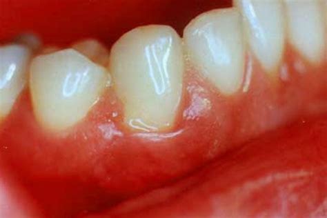 Swollen Uvula Causes Symptoms Treatment And Remedies Hubpages