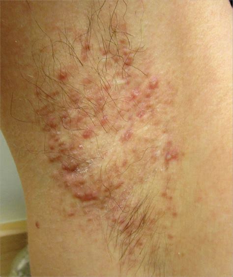 Axillary Acne Agminata Acne Jama Dermatology The Jama Network