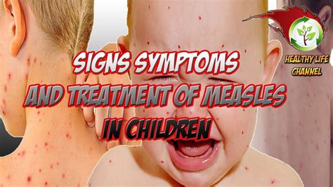 Signs Symptoms And Treatment Of Measles In Children Youtube