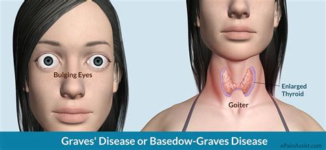 Graves Disease Amintamarquezlopezblock3