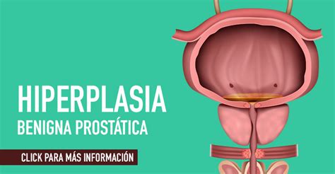 Hiperplasia benigna prostática Medicable
