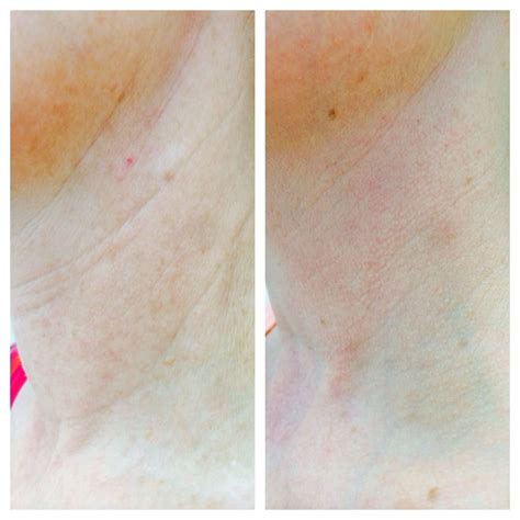 Medical Skin Needling To Improve Laxity Pigment And Wrinkles 6
