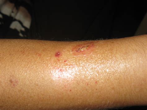 I Have A Skin Rash On My Forearms That Has Recently Turned