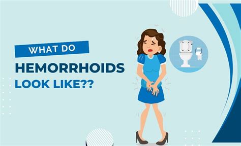 What Do Hemorrhoids Look Like Types And More Resurchify