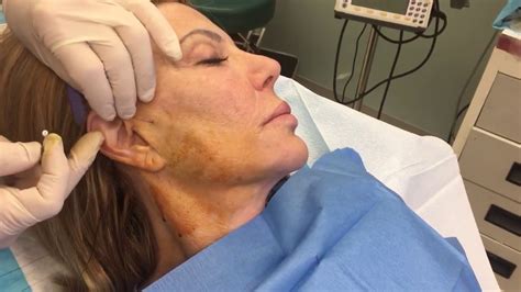 Lifting Facial Surgery Telegraph
