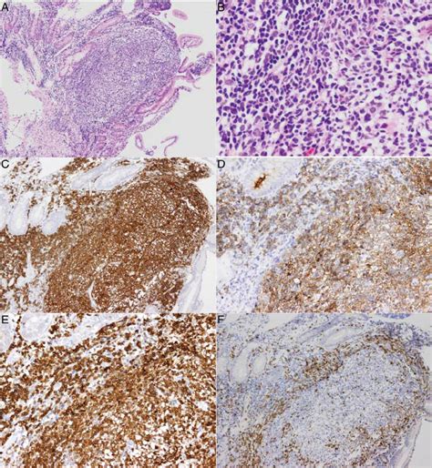A Case Of Primary Duodenal Follicular Lymphoma Grade 1 The Lesion