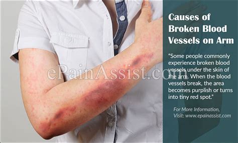 Causes Of Broken Blood Vessels On Arm And Home Remedies To Get Rid Of It