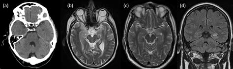 Acute Encephalitis Diagnosis And Management Rcp Journals