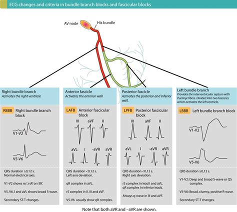 Overview Of Intraventricular Conduction Delay Defect Ecg Learning